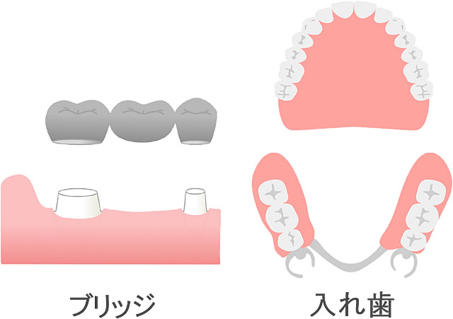 入れ歯
